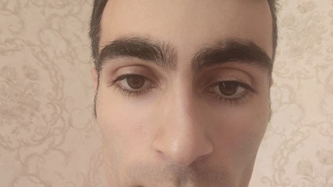 Saçımın ön hissesi seyrerlik oluşuyor hem de tarak bile vuramıyorum dökülür diye dikkat ediyorum sizce bir çare var mı?