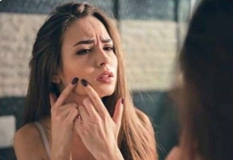 Sivilceleri olan kızlar beğenilmiyor mu?
