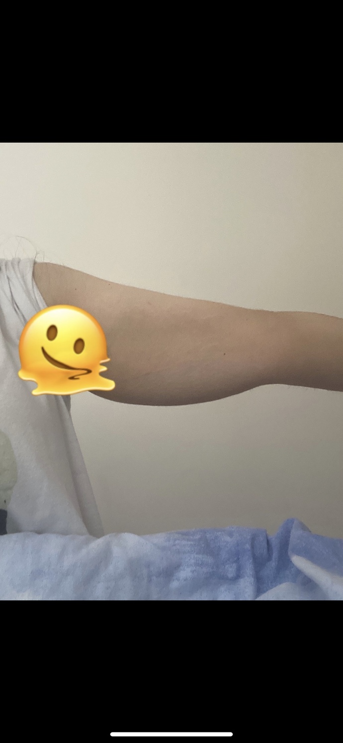 Bu kol sarkması sporla gider mi yoksa ameliyat şart mı?
