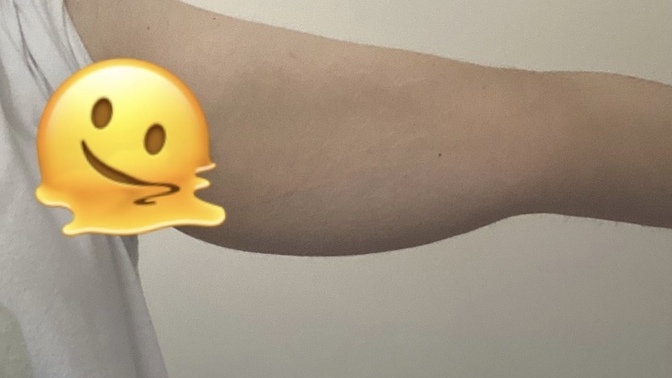 Bu kol sarkması sporla gider mi yoksa ameliyat şart mı?