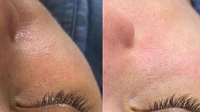 Dermapen ve BB glow bakımından sonra nelere dikkat etmeliyim?