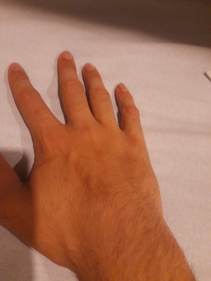 Sahip olduğunuz bir yara izi var mı, varsa nasıl oldu?