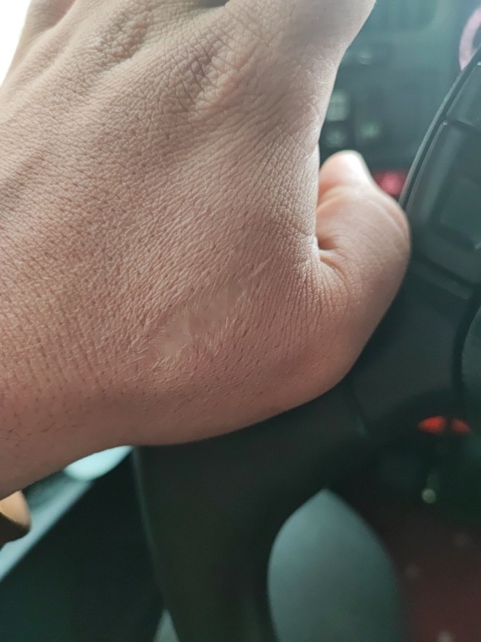 Sahip olduğunuz bir yara izi var mı, varsa nasıl oldu?