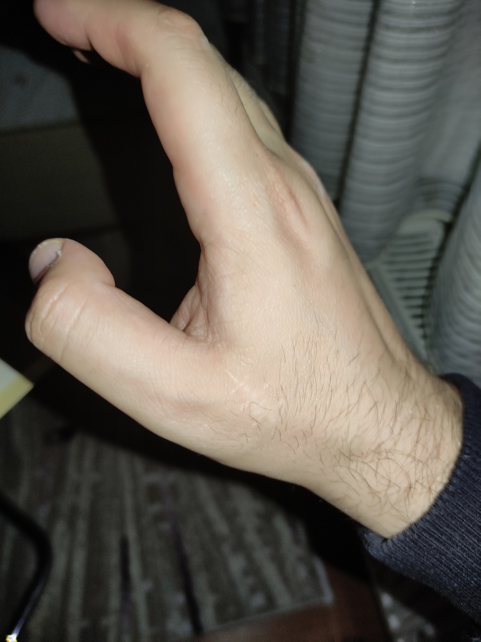 Sahip olduğunuz bir yara izi var mı, varsa nasıl oldu?