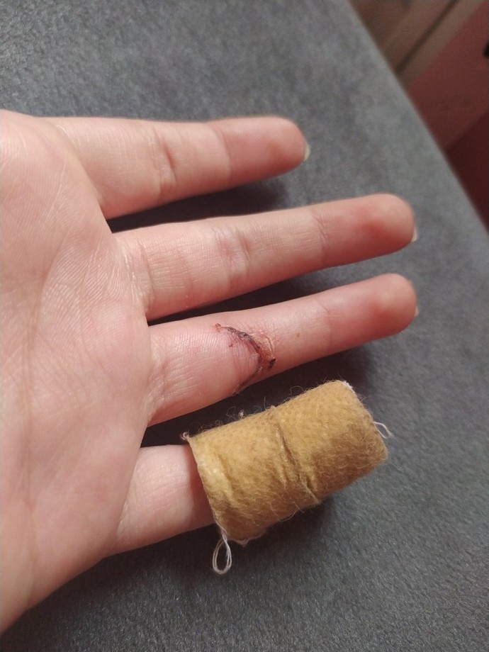 Elim 3 hafta önce kesildi hala acıyor?