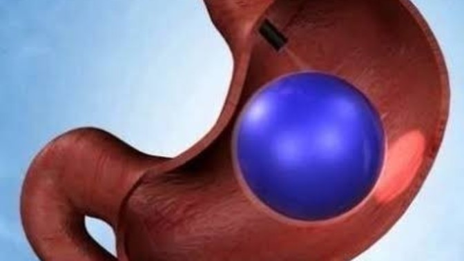 Mide balonu taktıran var mı?
