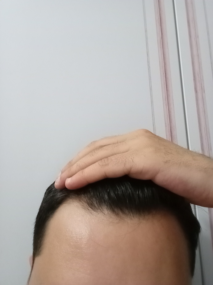 Sizce saçlarım dökülüyor mu?
