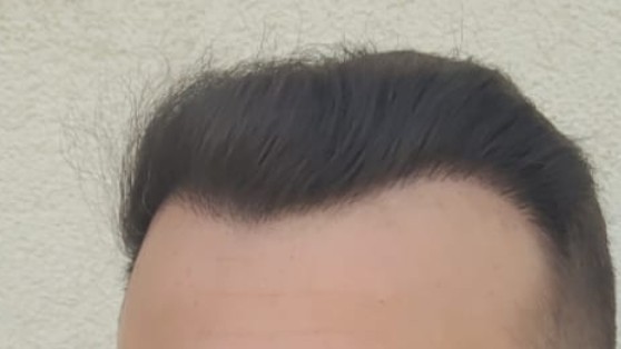 1 yıl önce saç ektirdim, öncesi sonrası değişim nasıl?
