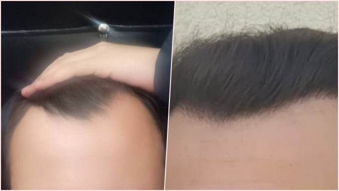 1 yıl önce saç ektirdim, öncesi sonrası değişim nasıl?