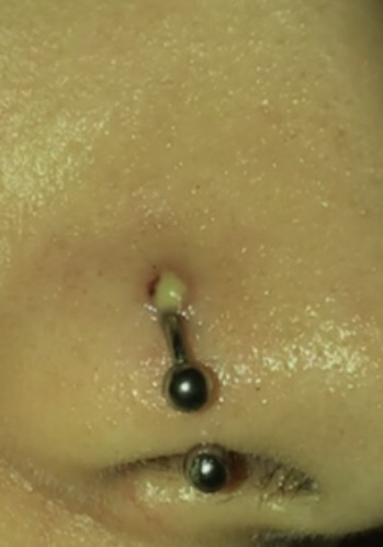 Burun piercing iltihabi nasıl geçer?