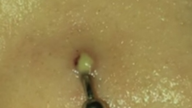 Burun piercing iltihabi nasıl geçer?