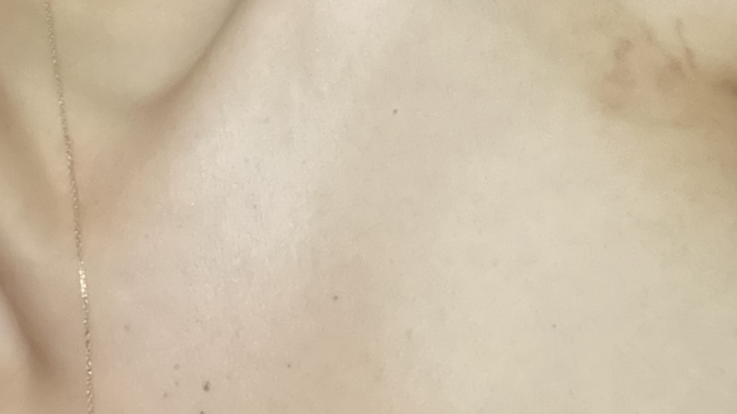 Arkadaşlar yanık izini ne ile geçirebilirim silverdin sürüyorum fakat iz için ne sürmem gerekiyor?