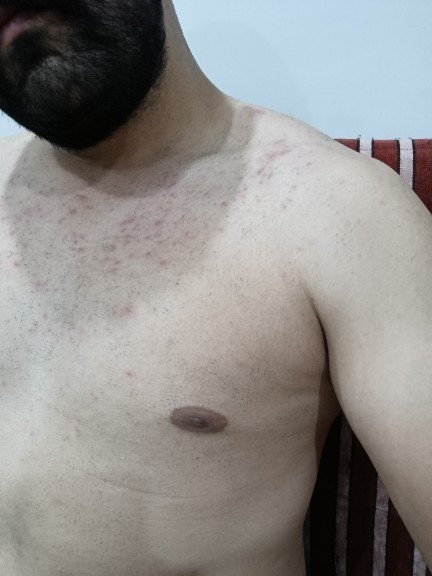 Epilasyon sonrası sivilcelenme normal mi?