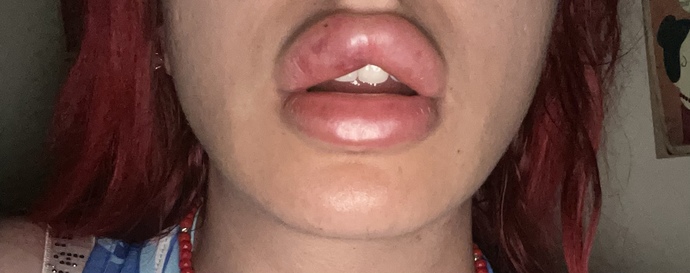 1 saat önce 2 cc dolgu yaptırdım bu şişlik normal mi?