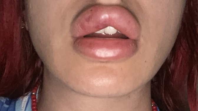 1 saat önce 2 cc dolgu yaptırdım bu şişlik normal mi?