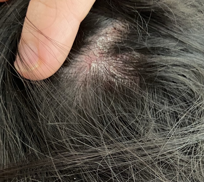 Seboreik dermatite ne iyi gelir?