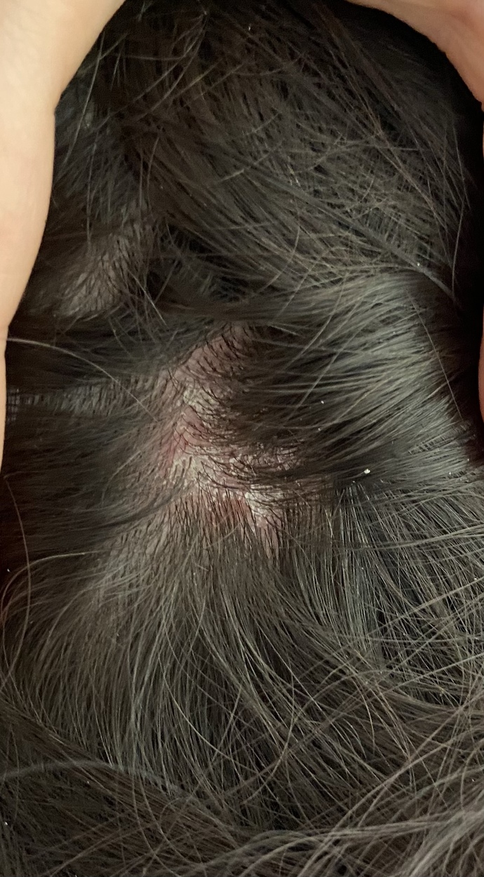 Seboreik dermatite ne iyi gelir?