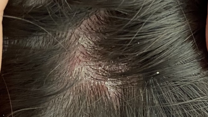 Seboreik dermatite ne iyi gelir?
