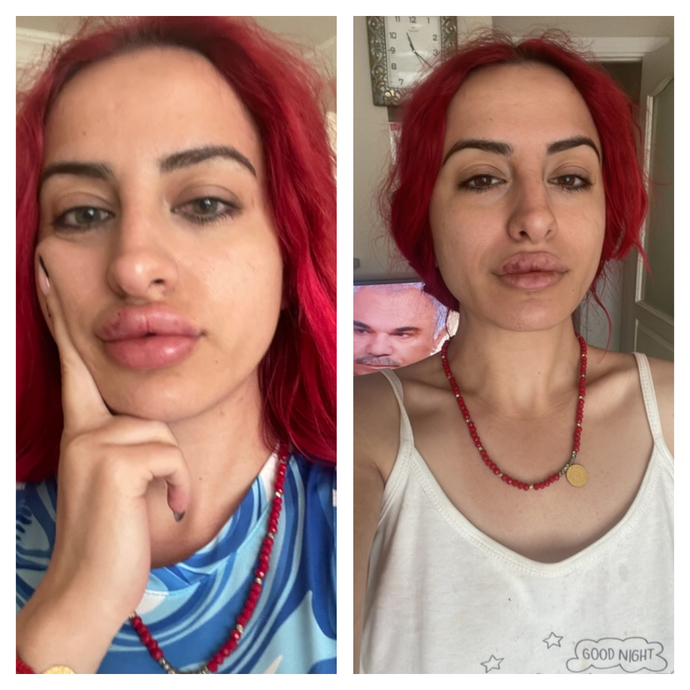 Dudak dolgum 3 günde eridi, benim dudaklarımda neden dolgu tutmuyor?