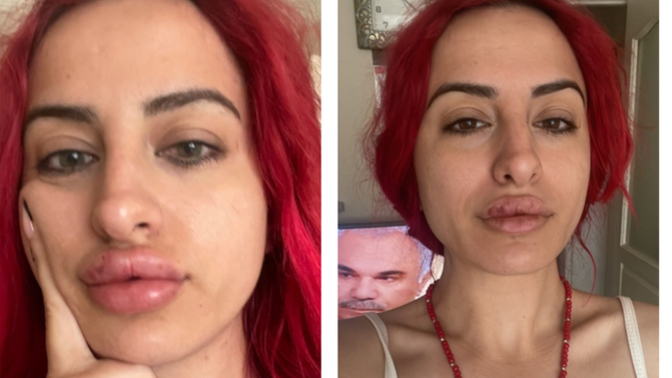 Dudak dolgum 3 günde eridi, benim dudaklarımda neden dolgu tutmuyor?