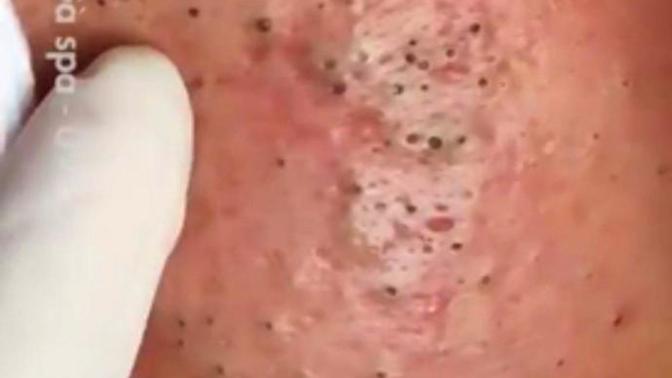 Siyah nokta videoları izleyip rahatalyan ben miyim sadece?