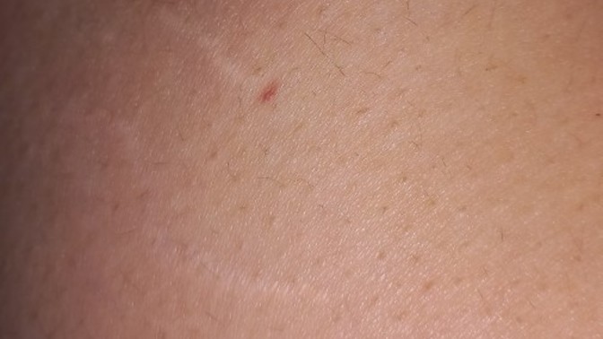 Aniden çıkan kırmızı lekeler nedir?