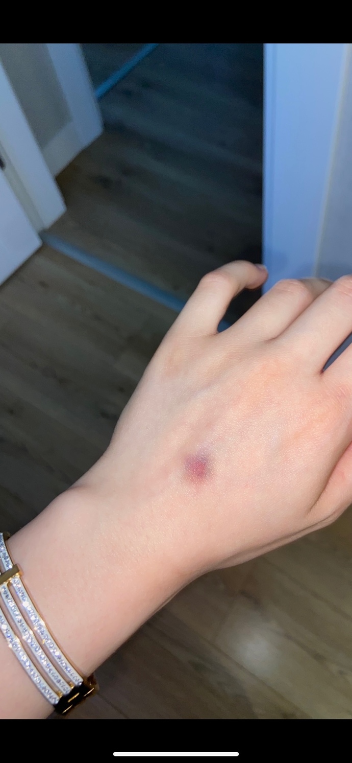 Elimde bi anda böyle bir morluk oluştu ve vücudumun bazı yerlerinde de farkettim morarmaları. Araştırdım kanser belirstinin olabileceği yazıyor bana saçma geldi, böyle bir durumla karşılaştınız mı?i