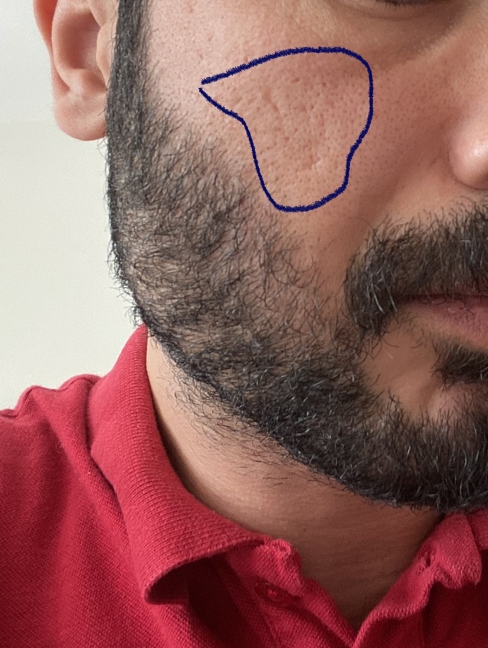 Yüzümdeki bu ufak delikler nasıl geçer?