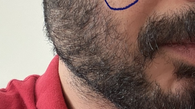 Yüzümdeki bu ufak delikler nasıl geçer?