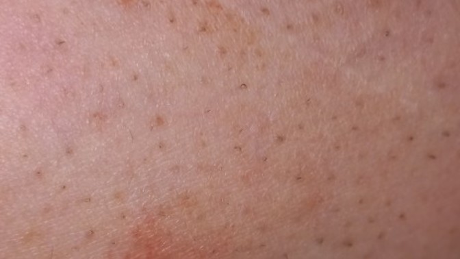 Bacağımda böyle bir şey var, 3 haftadır geçmedi. Nedir bu?