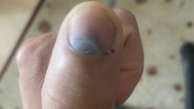 Eldeki morluk nasıl geçer?
