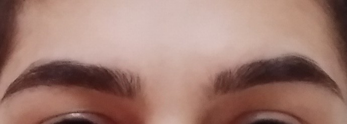 Kaşımın biri yukarıda duruyor, ne yaparsam yapayım düzelmiyor. Göz kapağı düşüklüğü mü?