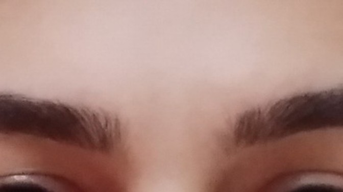 Kaşımın biri yukarıda duruyor, ne yaparsam yapayım düzelmiyor. Göz kapağı düşüklüğü mü?