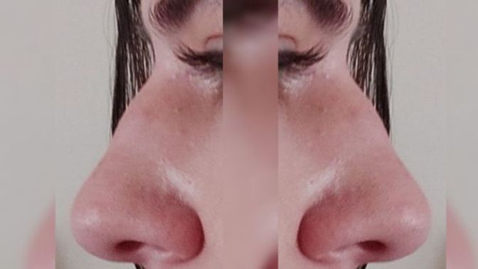 Doldu yaptırmayı düşünüyorum, burnuma dolgu olur mu?