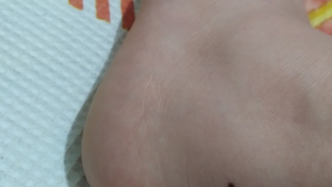 Sanırım ayak bileğimi burktum çok kötü acıyor basamıyorum üstüne ne yapmalıyım?