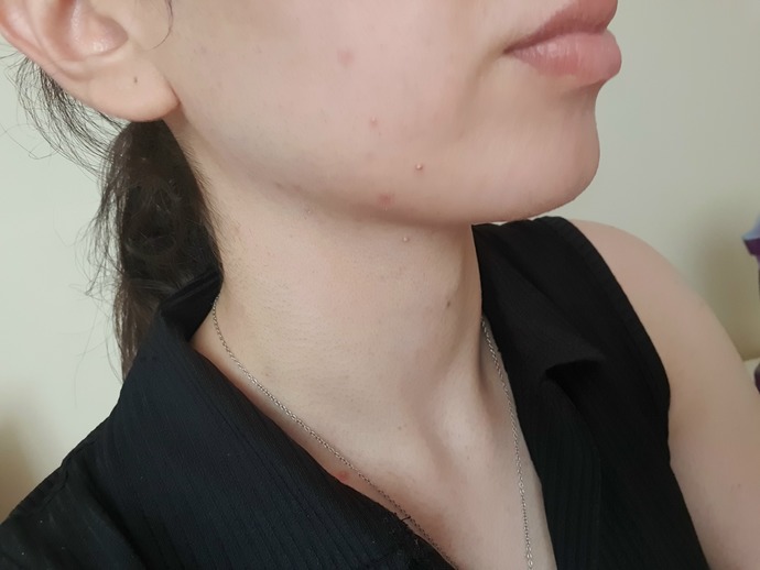 Yüzümde sivilceler var, nasıl geçirebilirim?