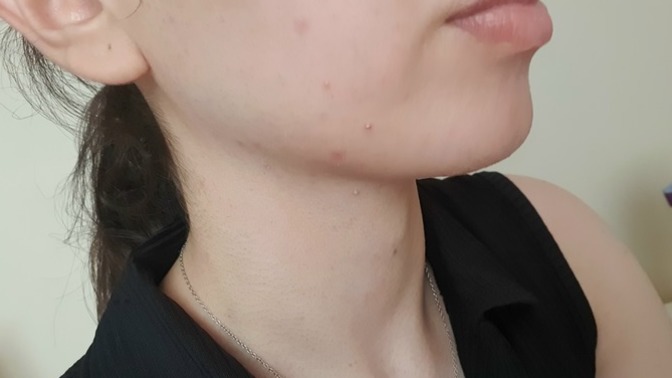 Yüzümde sivilceler var, nasıl geçirebilirim?