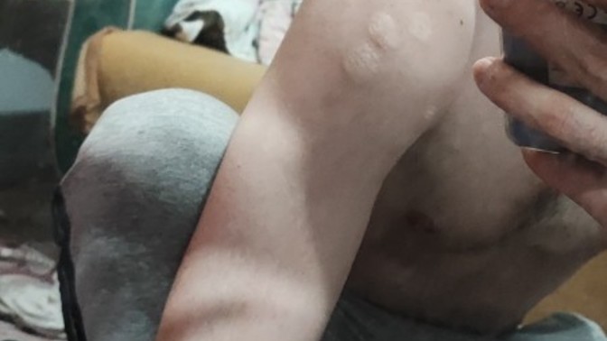 Kolumdaki yara izine hangi dövme yakışır sizce?