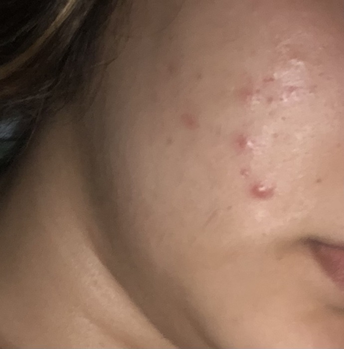Sivilce hapı tavsiye ede misiniz?