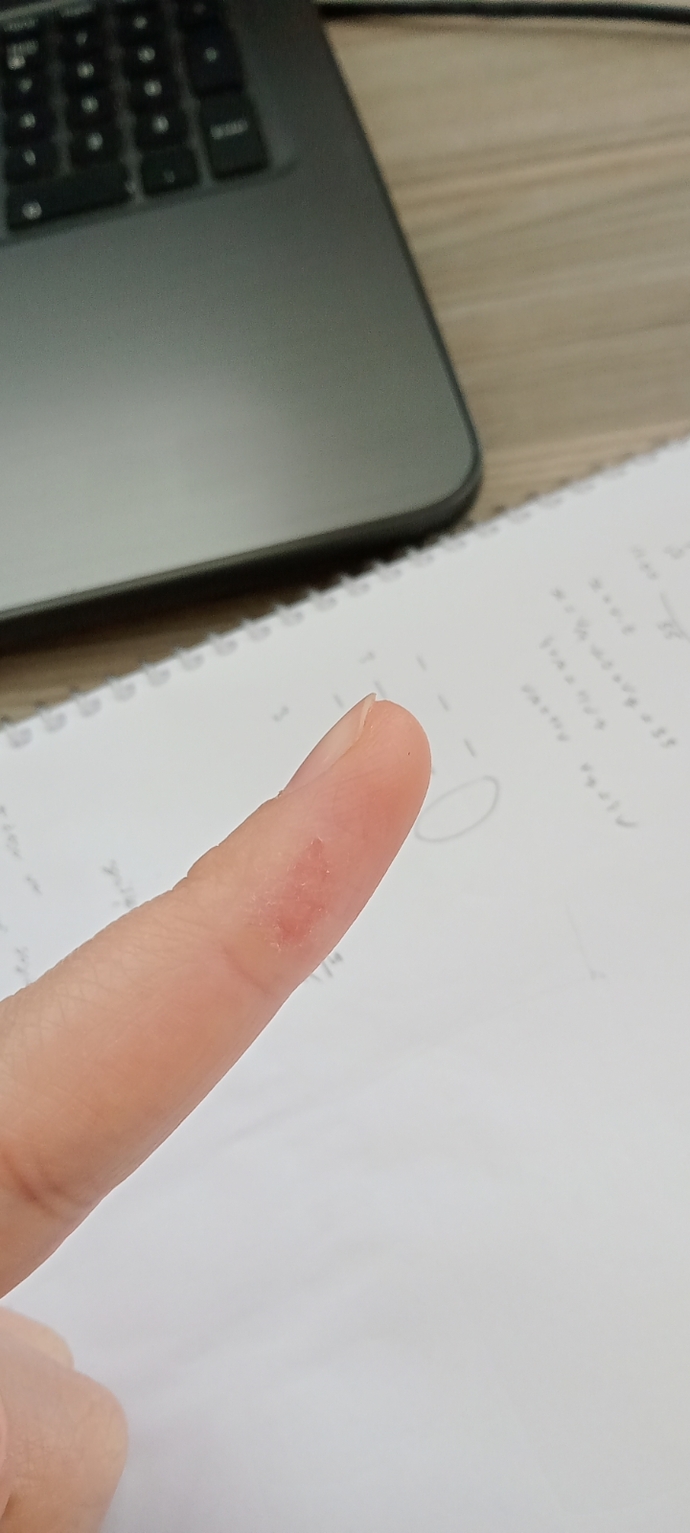 Yara değil böyle soyuluyor minik bir kısmı. Doktora gitsem buna mı geldin diye söver