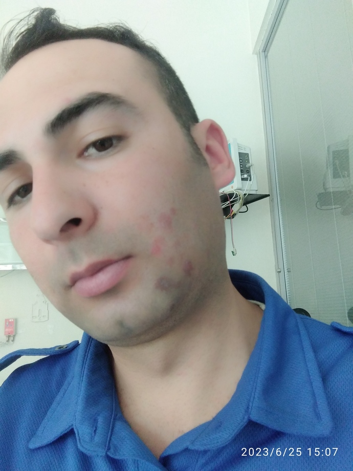 Yemek yaparken yuzume kızgın yag sıcradısizce ızı? Kalırmı?