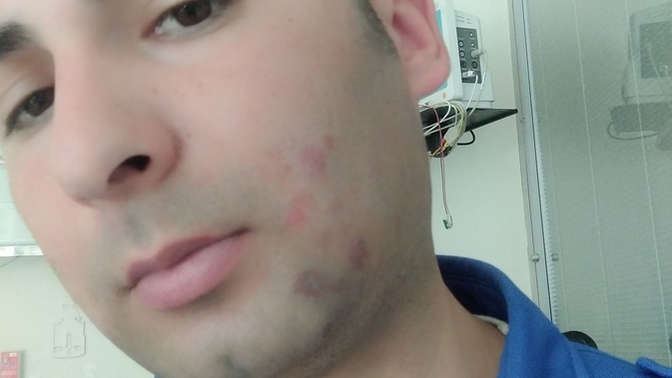Yemek yaparken yuzume kızgın yag sıcradısizce ızı? Kalırmı?