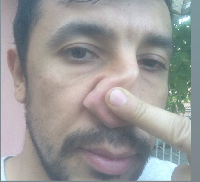 Sizce burun estetiği yüzümü değiştirir mi?