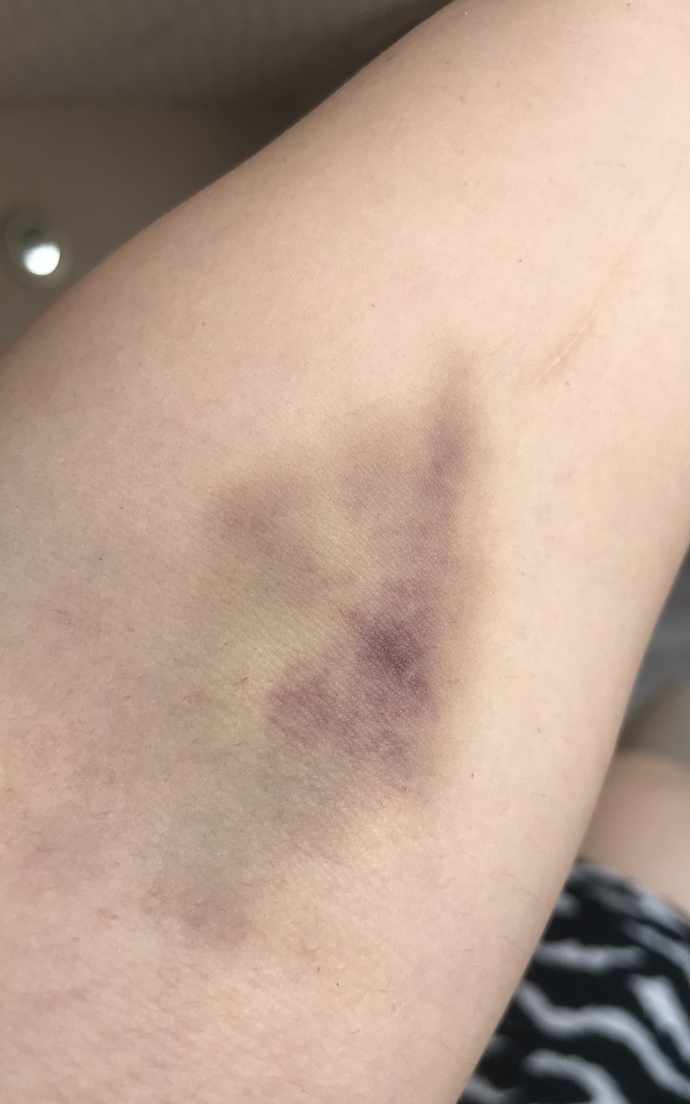 Arkadaşlar geçen hafta çarşamba günü sağlık raporu için 3 tüp kan alındı kolum şişmişti o gün sürekli mordu son durumu bu normal mi