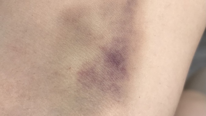 Kolumdan 3 tüp kan alındı, morarması normal mi?