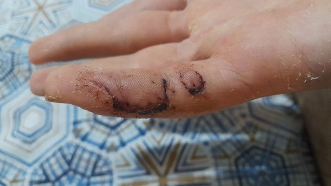 Dikiş alınan yaraya kolonya dökülür mü, dikiş alınalı 4 gün oldu?