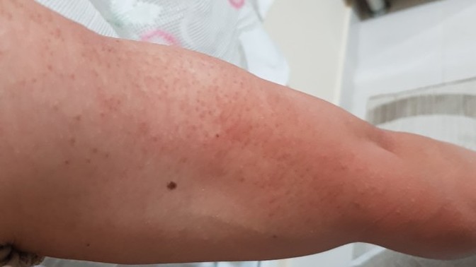 Kolumda böyle küçük sivilceler var, nasıl geçer?
