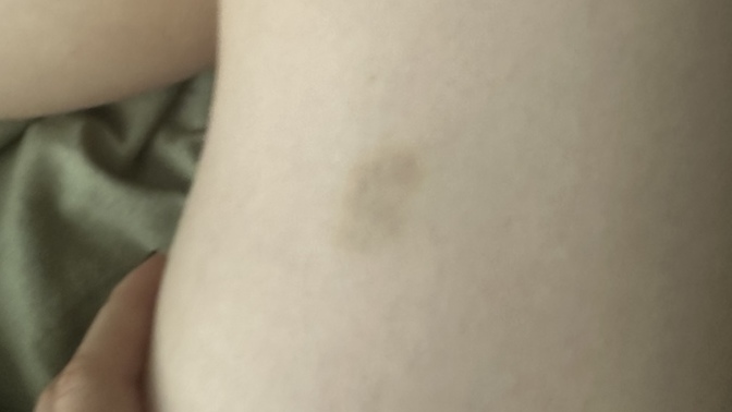 Bacağımda böyle morluk var, cilt kanseri değilimdir değil mi?