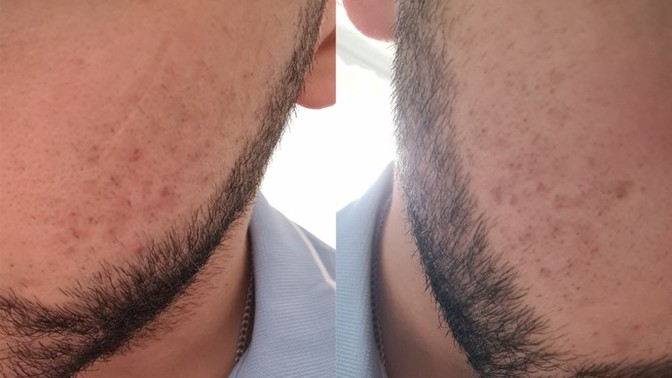 Yanaklarımda böyle kızarıklıklar var, nasıl geçer?