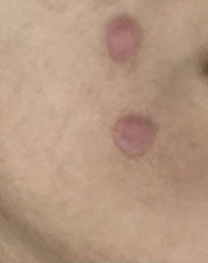 Egzama için eczaneden krem hazırlattırmıştık ciltteki yanığa da iyi gelir mi?